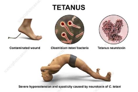 tt ng tao|Tetano (Tetanus) .